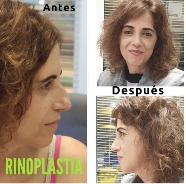Me Quiero Operar La Nariz Me quiero operar la nariz, pero me da miedo - Dr Valdés